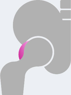 Hip with a Cam Impingement