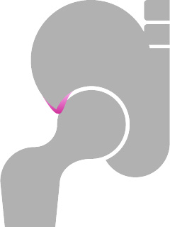 Hip wih a Pincer Impingement